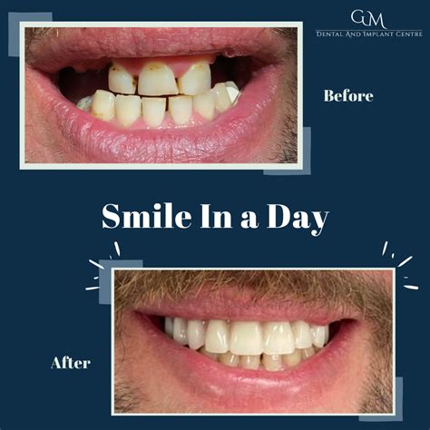 same day teeth in ashford|Smile in a day Dental Implants Rochester, Ashford & Barnet.